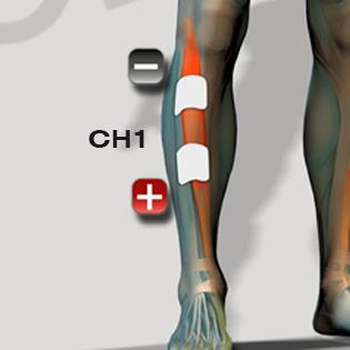 Ön kaval (tibialis anterior) yerleşim örneği — Globus Genesy 600 kullanım kılavuzu
